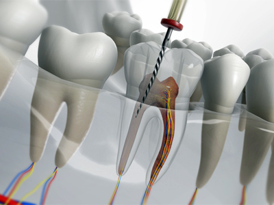root-canal-davie-1